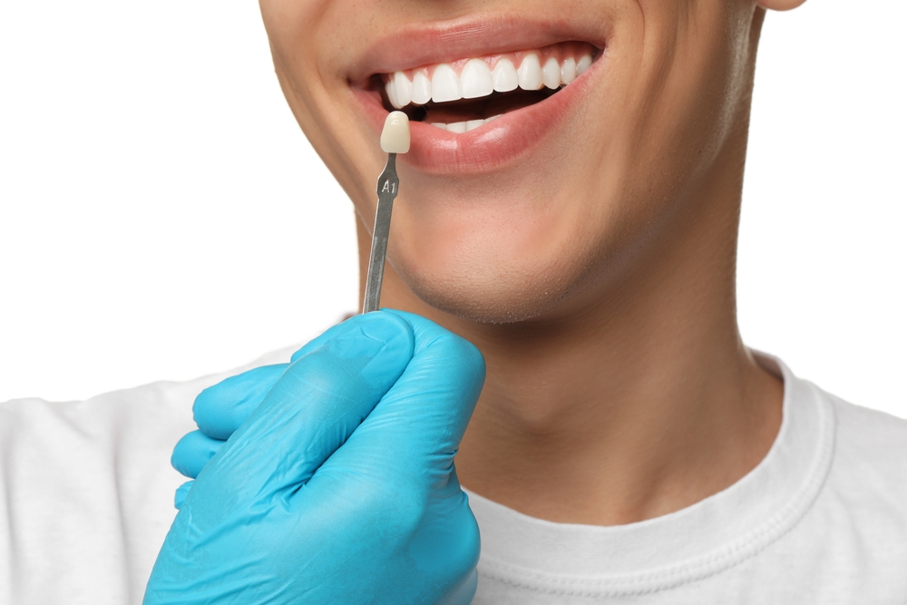 Dental Veneers in Spirit Lake